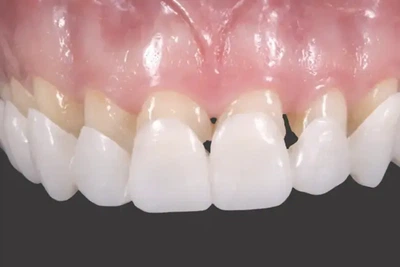 Виниры для зубов верх Snap On Smile легкие в использовании подходят каждому