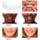 Съемные виниры для зубов Snap On Smile - изображение 8