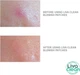 Гідроколоїдні точкові патчі від прищів LivaClean Blemish Hydrocolloid Patch Stickers 48 шт - зображення 4