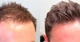 Лосьйон minoxidil 5% KIRKLAND (3 флакона) + мезороллер - зображення 4