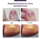 Набір пластирів Elastic Toenail Correction Sticker (50 pcs) для корекції нігтів, що вростають (ECS1000) - зображення 5