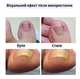 Набір пластирів Elastic Toenail Correction Sticker для корекції та усунення врослих нігтів (50 шт.) - зображення 3