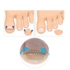 Спіральний фіксатор коректор для врослих нігтів Ingrown Toenail Lift 12 штук - изображение 7