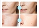Очищаюча пінка із саліциловою кислотою Bioaqua Salicylic Acid Acne Removal Cleanser, 100 г, (W3-02681) - зображення 4