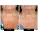 Светодиодная маска CurrentBody Skin LED Neck and Dec Perfector для шеи и декольте - изображение 3