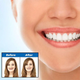Накладка на зуби Tooth Cover вініри Perfect Smile - зображення 5