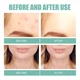 Патчі від акне Eelhoe Acne Patch, патчі для очищення та звуження пор, 132 шт - изображение 5