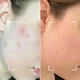 Светодиодная маска CurrentBody Skin Anti-Imperfections LED Face Mask: Series 2 против несовершенств кожи - изображение 7