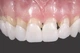 Виниры для зубов верх Snap On Smile легкие в использовании подходят каждому - изображение 1