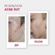 Biotrade (Біотрейд) Acne Out Active Lotion – активний лосьйон для проблемної шкіри з запальними формами акне, 60 мл - зображення 2