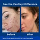 Пенка для умывания против акне Acne Foaming Wash Panoxyl 10%, 85 g - изображение 2