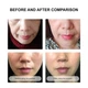 Secret Strips Anti-Wrinkle Smile Line Patches пластирі від зморшок для обличчя та носогубних складок з сироваткою для ліфтингу та оновлення шкіри 10 шт. + 8 мл - зображення 3