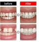 Накладные зубы Snap-On Veneers Временные виниры, накладка для улыбки - изображение 11