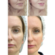 Микротоковый RF лифтинг массажер для лица MEDICA+ Skin Lifting 7.0 White EMS LED - изображение 7