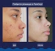 Пінка для вмивання від акне для обличчя та тіла PanOxyl Acne Foaming Wash for Face Body 85 г - зображення 6