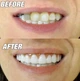 Виниры для зубов Smile Veneers, на две челюсти, многоразовые съемные накладки на зубы, из безопасных медицинских материалов, белые - изображение 4
