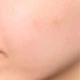 Патчі від висипань SKIN1004 Spot Cover Patch 22 шт - зображення 4