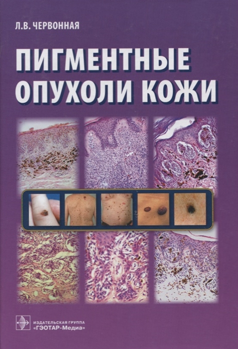 

Пигментные опухоли кожи (1179754)