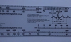 Кардиологическая линейка для анализа электрокардиограммы ЭКГ (mpm_00088) - изображение 7