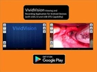 Видеоларингоскоп взрослый VividTrac Adult VT-A100 - изображение 3