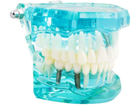 Стоматологическая модель с зубами, кариесом, имплантом, периодонтитом, камнем - изображение 6