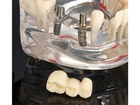 Стоматологическая модель с зубами, кариесом, имплантом, периодонтитом, камнем - изображение 8