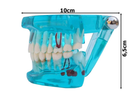 Стоматологічна модель із зубами, карієсом, імплантом, періодонтитом, каменем. - зображення 9